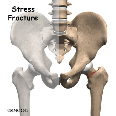 Stress Fracture of the Hip
