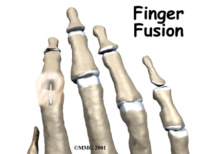Finger Fusion Surgery - Evidence Sport and Spine's Guide